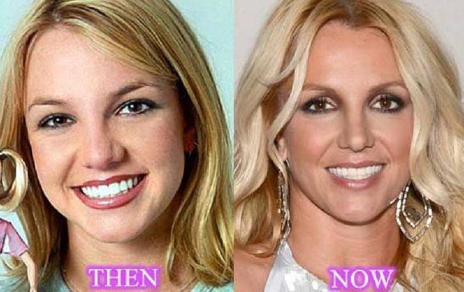 Britney Spears Before And After Plastic Surgery Reveals Her Popstar